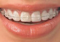 Dr. Espinosa is certified to provide 6-month braces.