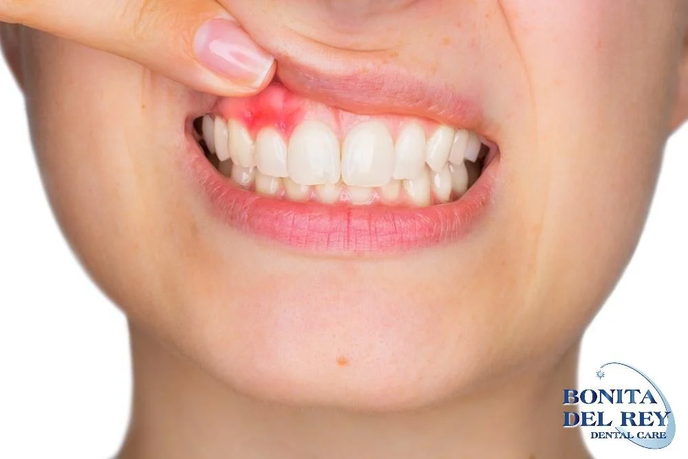 gum-disease-bonita-del-rey