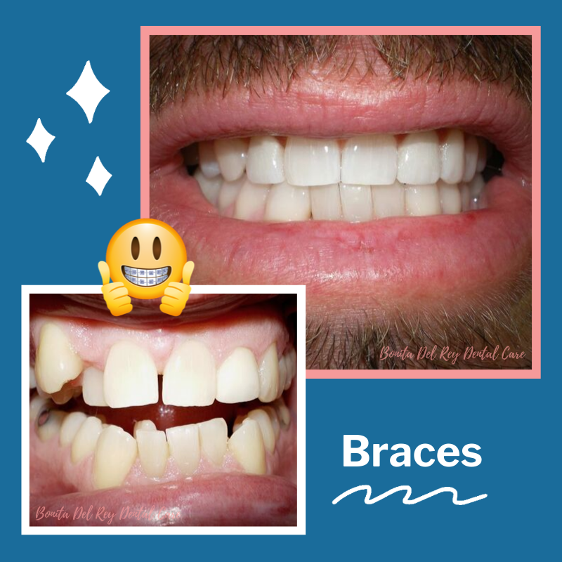 Braces Before After