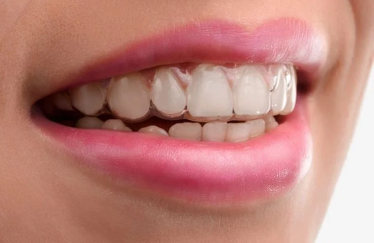 dental-patient-wearing-invisalign-1