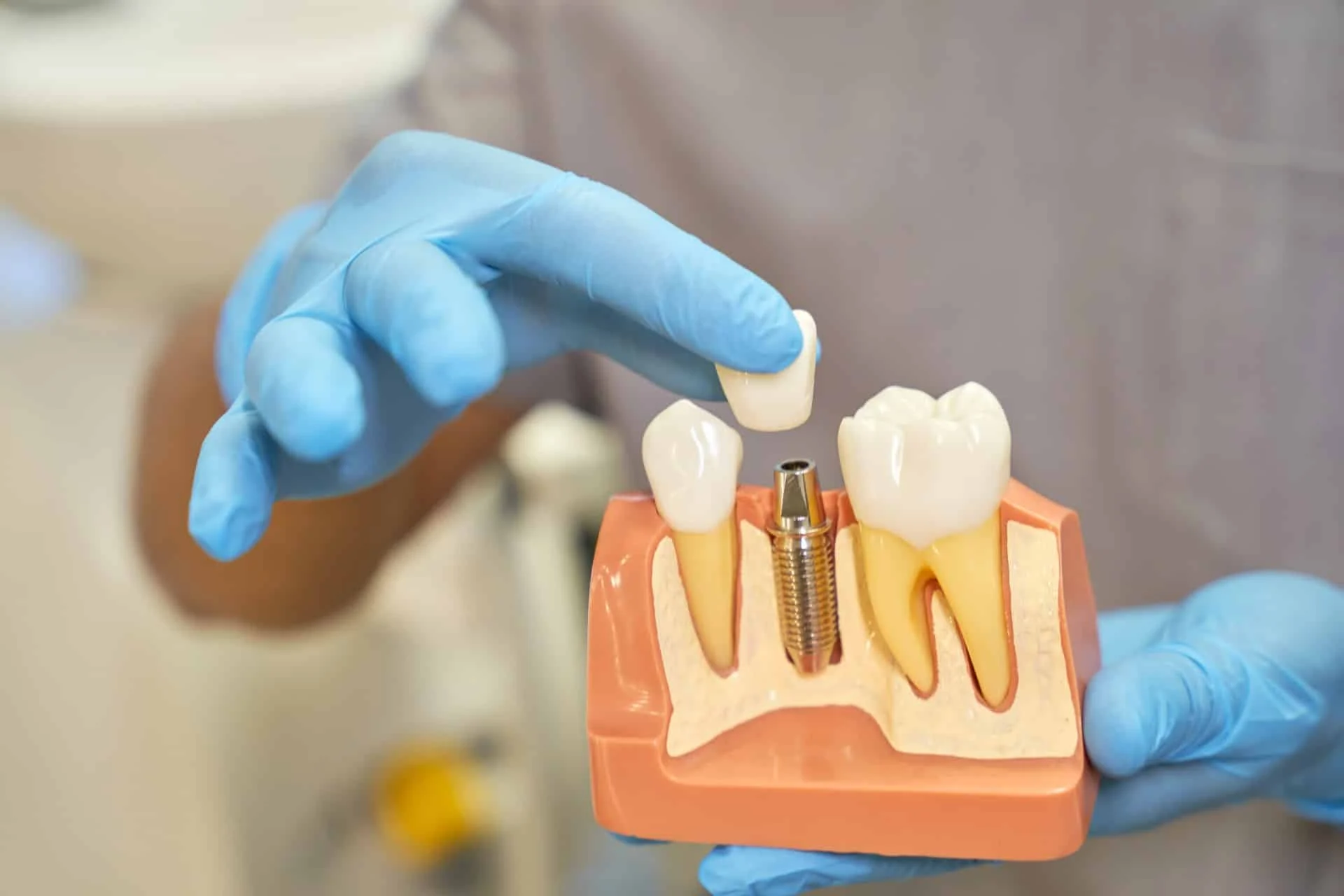 How Long Does a Tooth Implant Take?