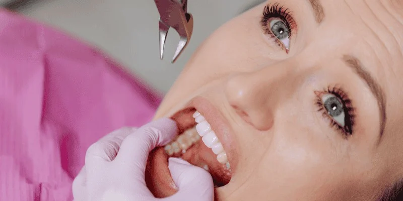 The Surgical Extraction Process What to Expect