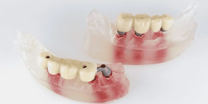 Immediate Loading and Temporary Restorations