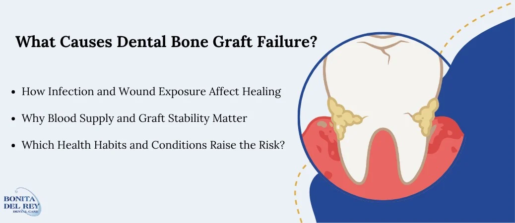 Why Dental Bone Grafts Can Fail