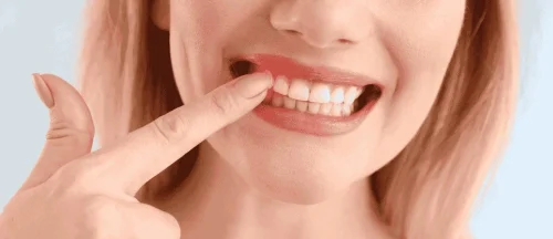 Woman pointing to her gums while smiling