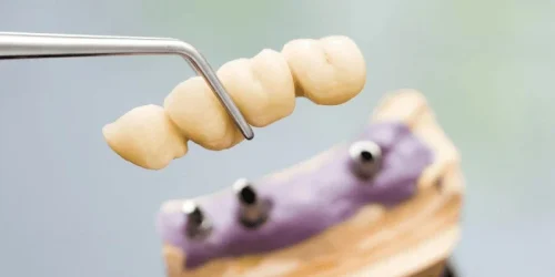 dental implants vs bridges comparison