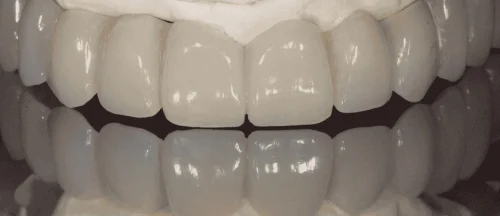 full arch prosthesis survival rates by material