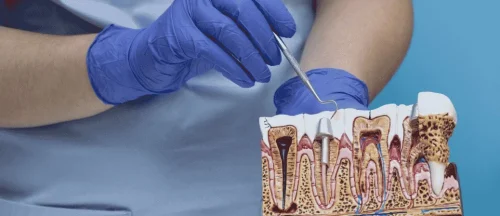 gum disease and dental implant failure