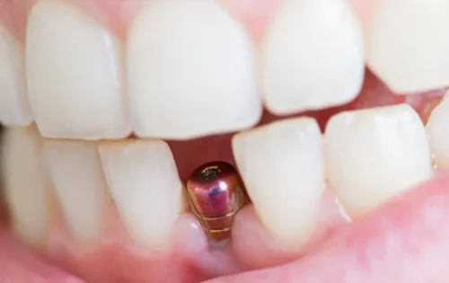 single mini implant